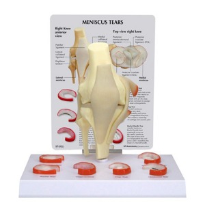 오픈메디칼GPI 무릎관절 반월상연골파열 모형 G1010